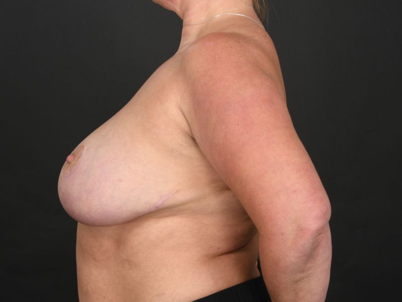 Breast Lift Before & After Image