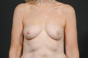 Breast Reconstruction Before & After Image