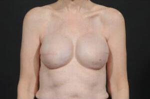 Breast Reconstruction Before & After Image