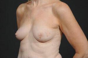 Breast Reconstruction Before & After Image