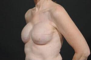 Breast Reconstruction Before & After Image