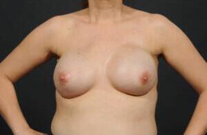 Breast Reconstruction Before & After Image