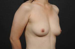 Breast Reconstruction Before & After Image