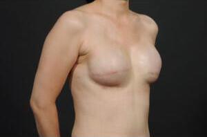 Breast Reconstruction Before & After Image