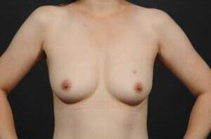 Breast Reconstruction Before & After Image