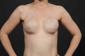 Breast Reconstruction Before & After Image