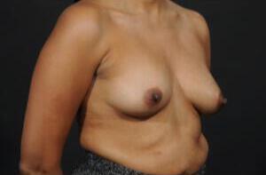 Breast Reconstruction Before & After Image