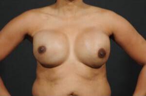 Breast Reconstruction Before & After Image