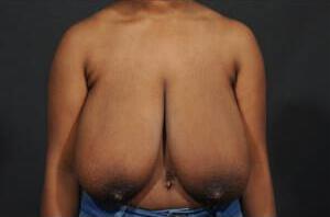 Breast Reduction  Before & After Image