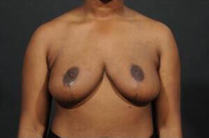 Breast Reduction  Before & After Image