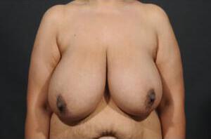 Breast Reduction  Before & After Image