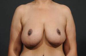 Breast Reduction  Before & After Image