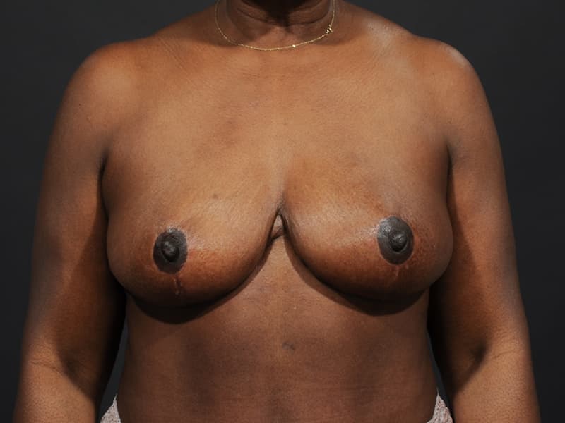 Breast Reduction  Before & After Image