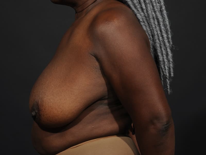 Breast Reduction  Before & After Image