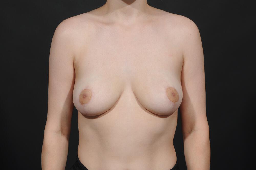 Breast Reduction  Before & After Image