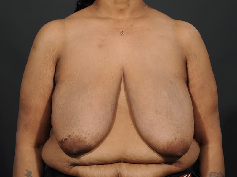 Breast Reduction  Before & After Image