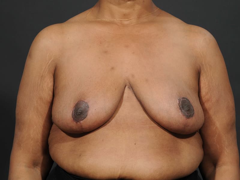 Breast Reduction  Before & After Image