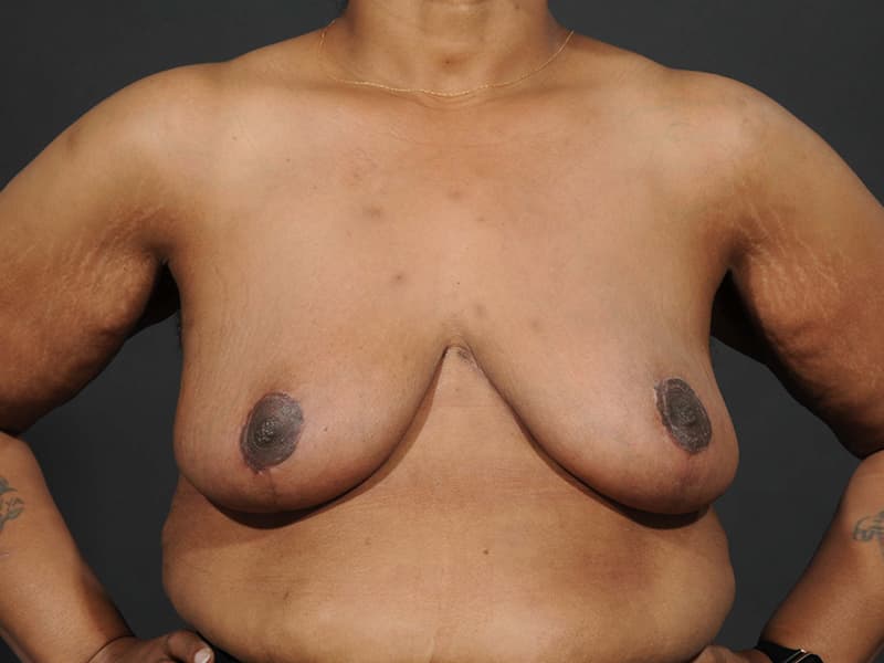 Breast Reduction  Before & After Image