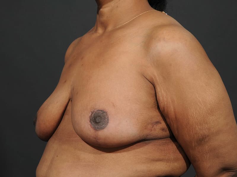 Breast Reduction  Before & After Image