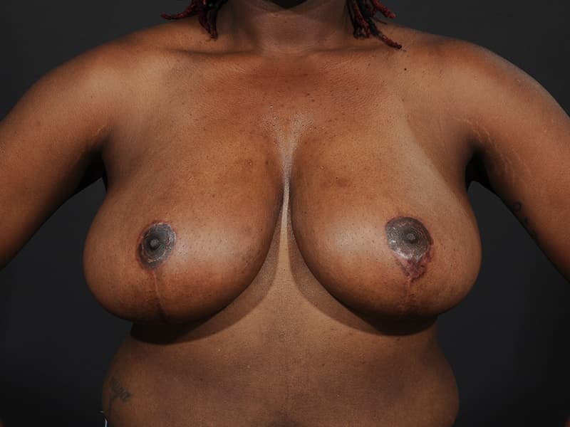 Breast Reduction  Before & After Image