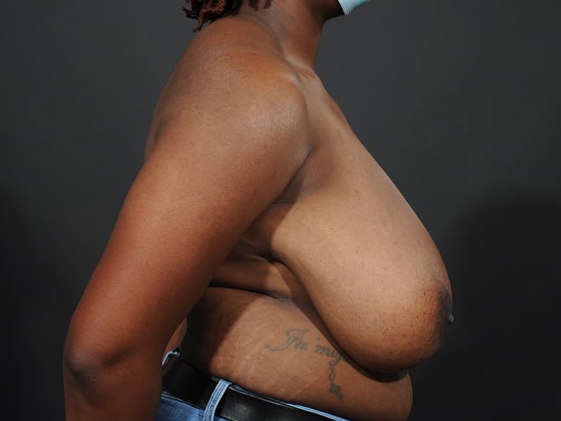 Breast Reduction  Before & After Image