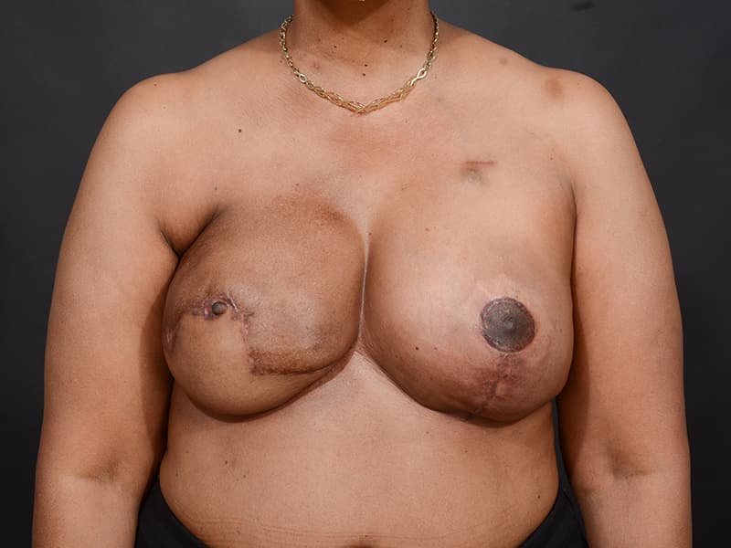 DIEP Flap Reconstruction Before & After Image