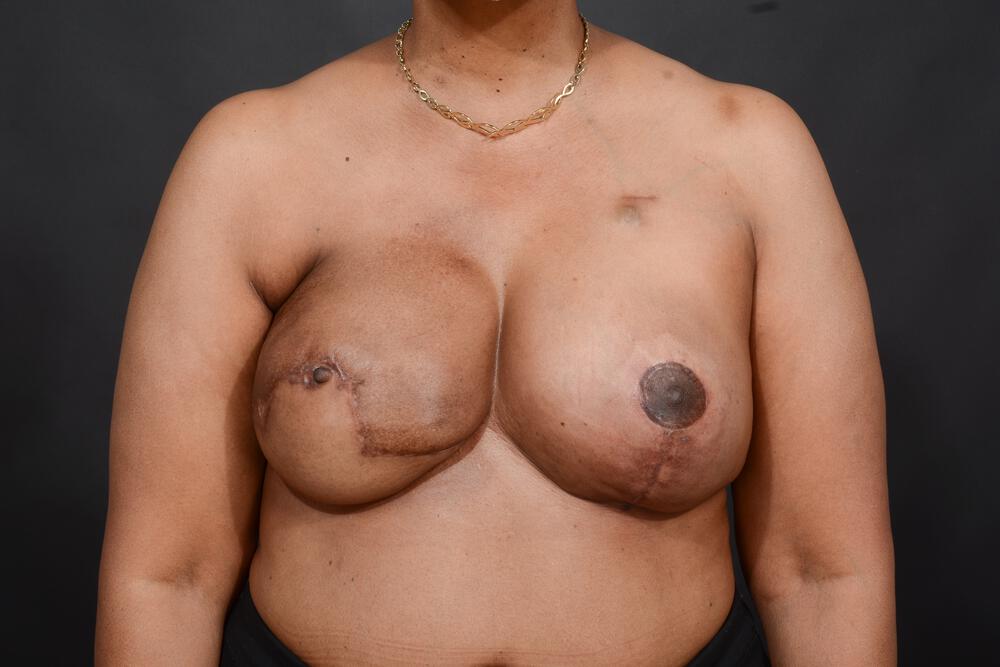 DIEP Flap Reconstruction Before & After Image