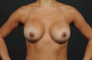 Breast Implant Exchange Before & After Image