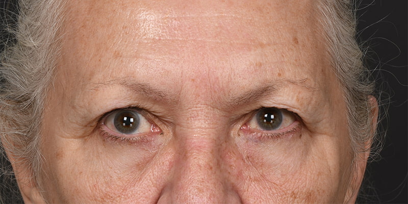 Brow Lift Before & After Image