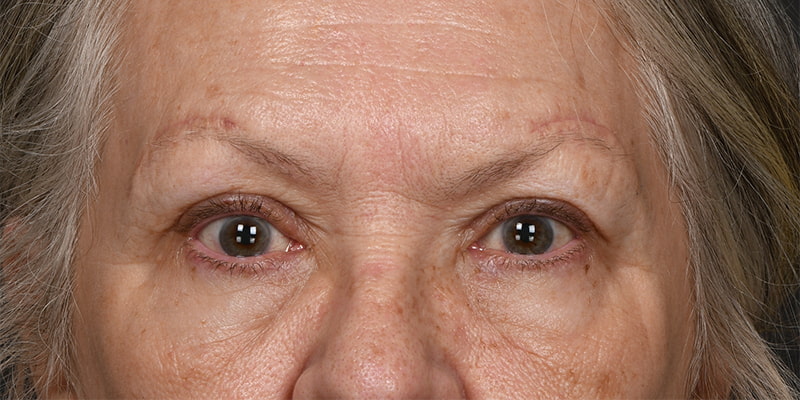 Brow Lift Before & After Image