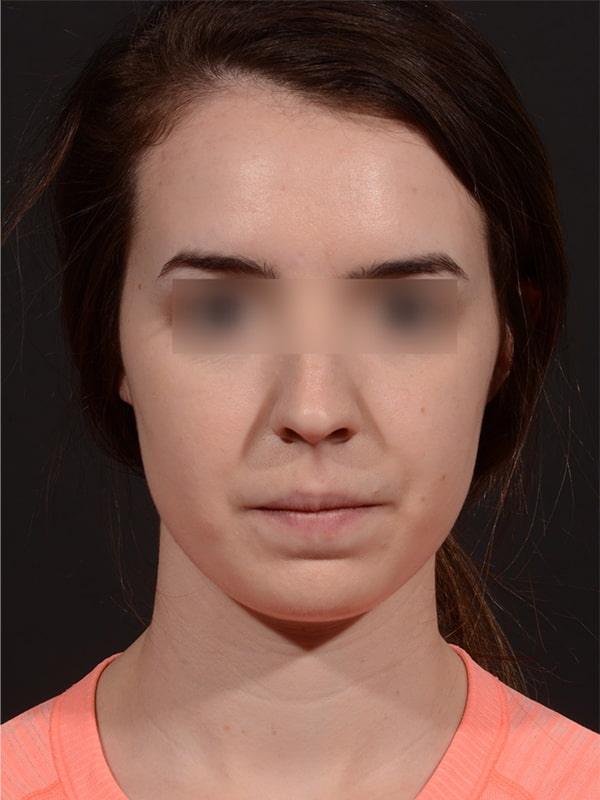 Chin Augmentation Before & After Image