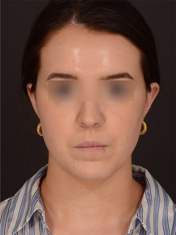 Chin Augmentation Before & After Image