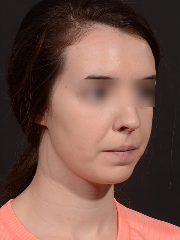 Chin Augmentation Before & After Image