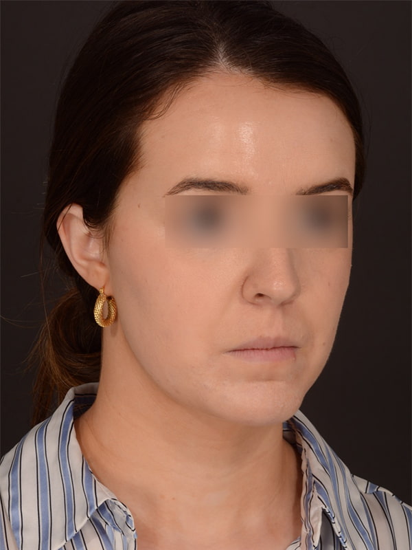 Chin Augmentation Before & After Image