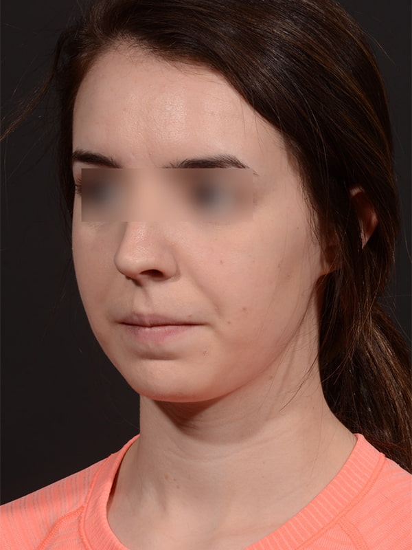 Chin Augmentation Before & After Image