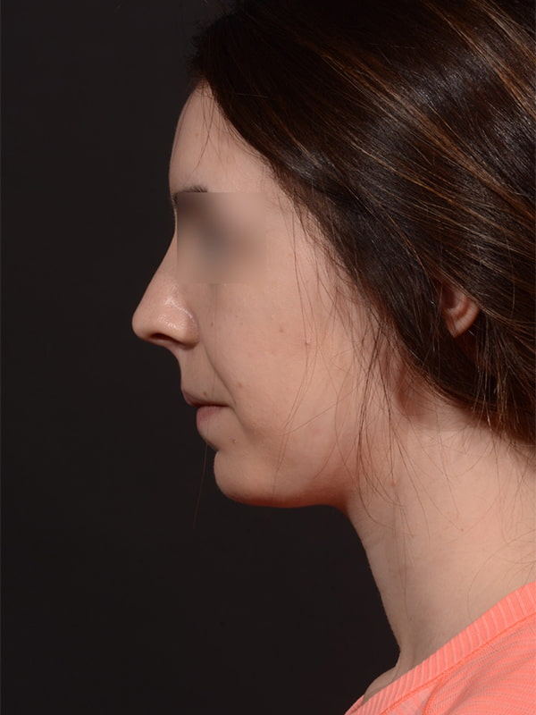 Chin Augmentation Before & After Image