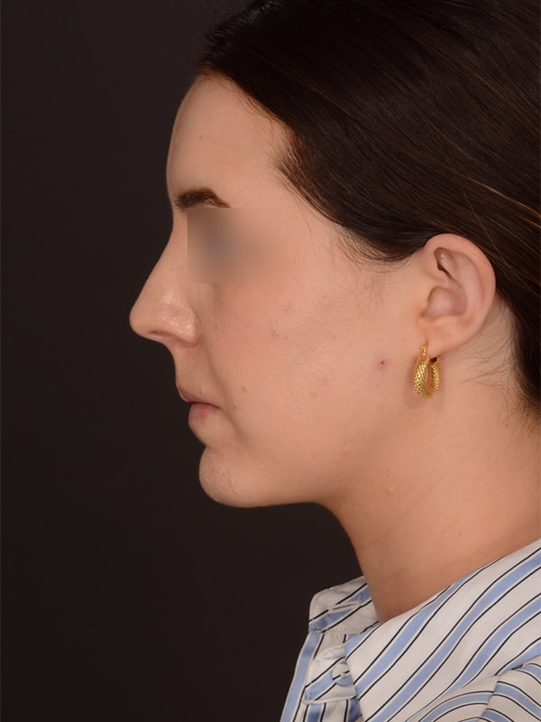 Chin Augmentation Before & After Image