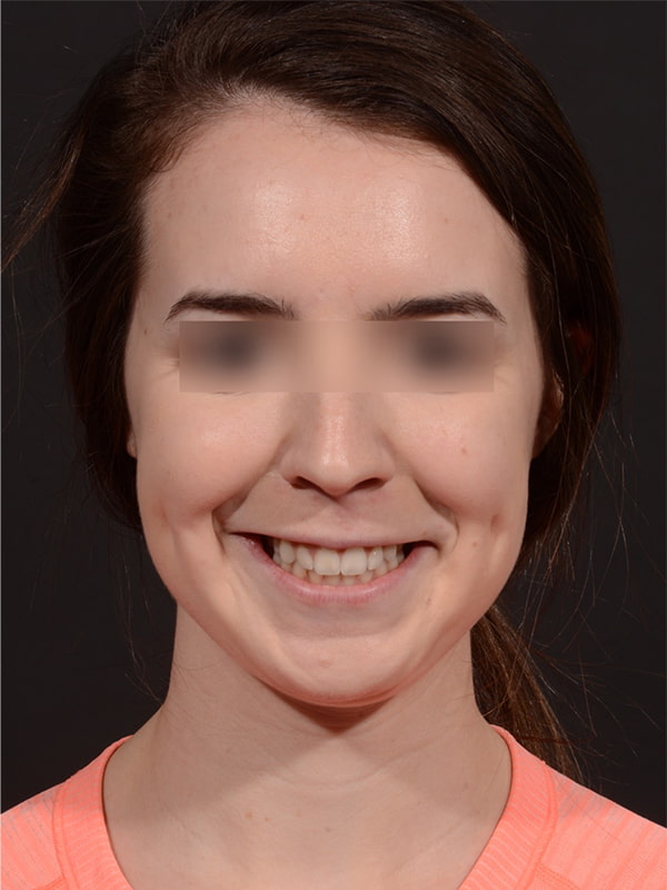 Chin Augmentation Before & After Image