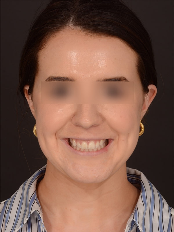 Chin Augmentation Before & After Image