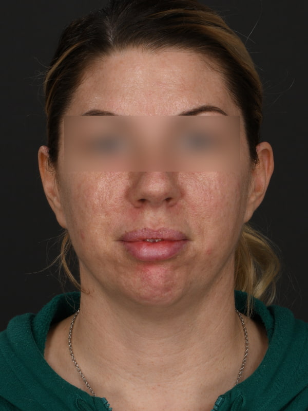 Chin Augmentation Before & After Image