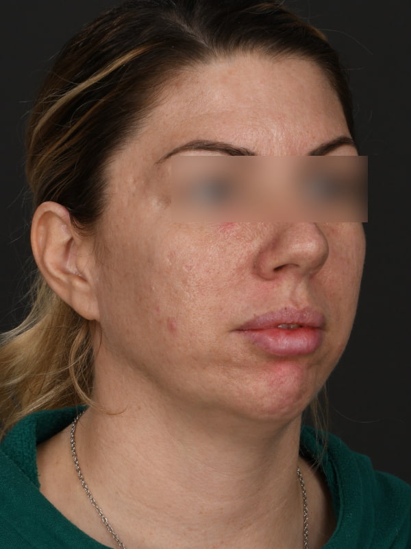 Chin Augmentation Before & After Image