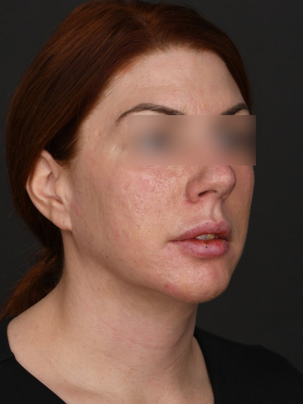 Chin Augmentation Before & After Image