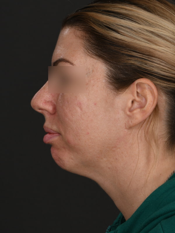 Chin Augmentation Before & After Image