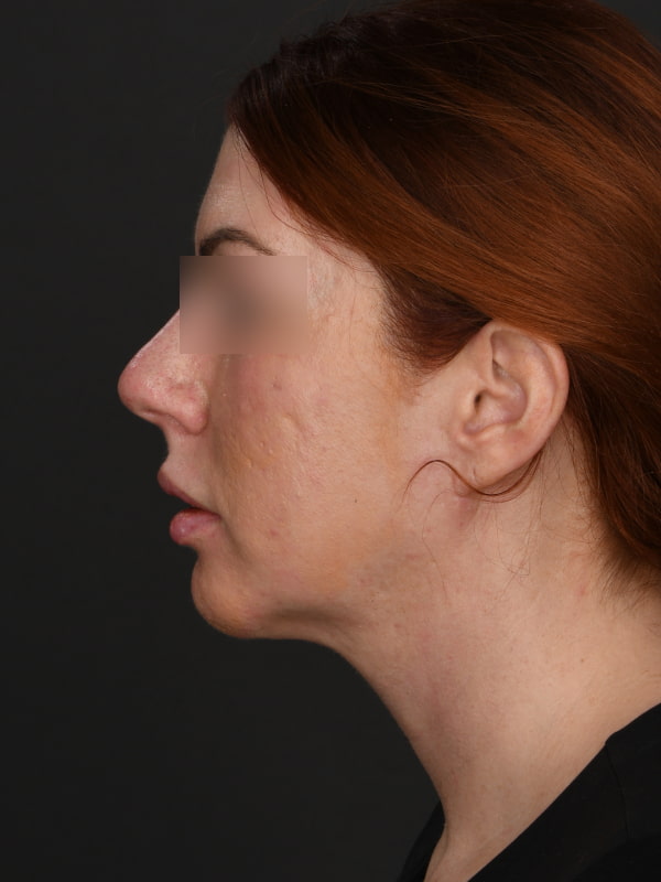 Chin Augmentation Before & After Image