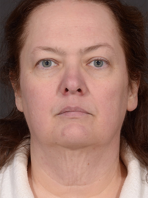 Face and Neck Lift Before & After Image