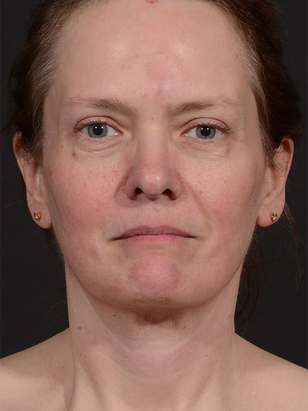 Face and Neck Lift Before & After Image