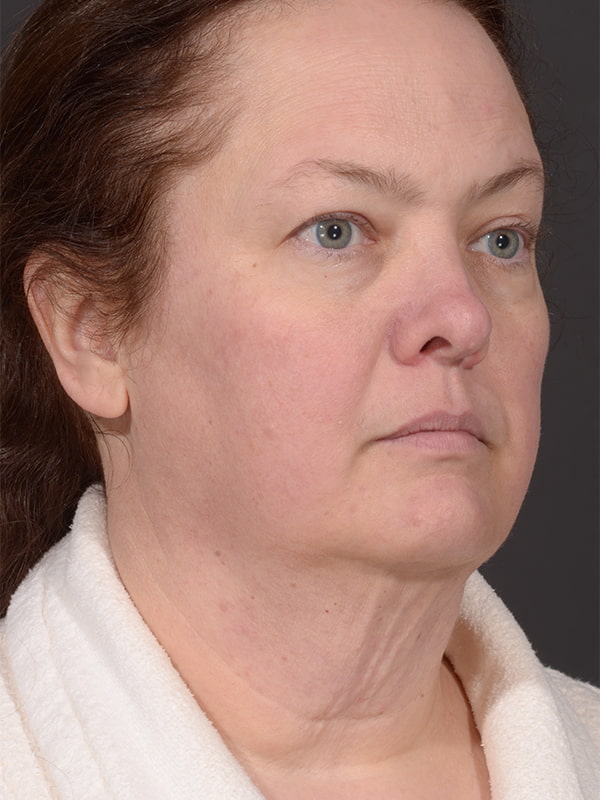 Face and Neck Lift Before & After Image