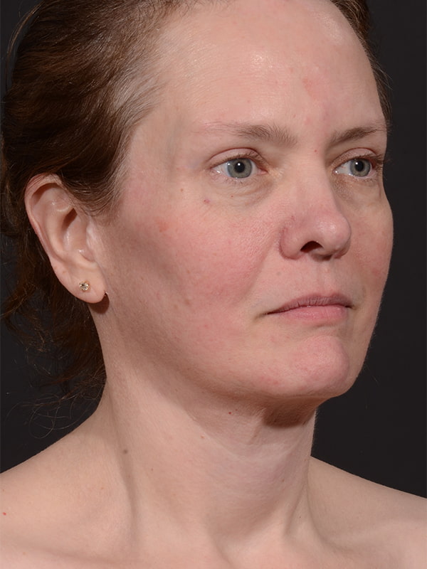 Face and Neck Lift Before & After Image