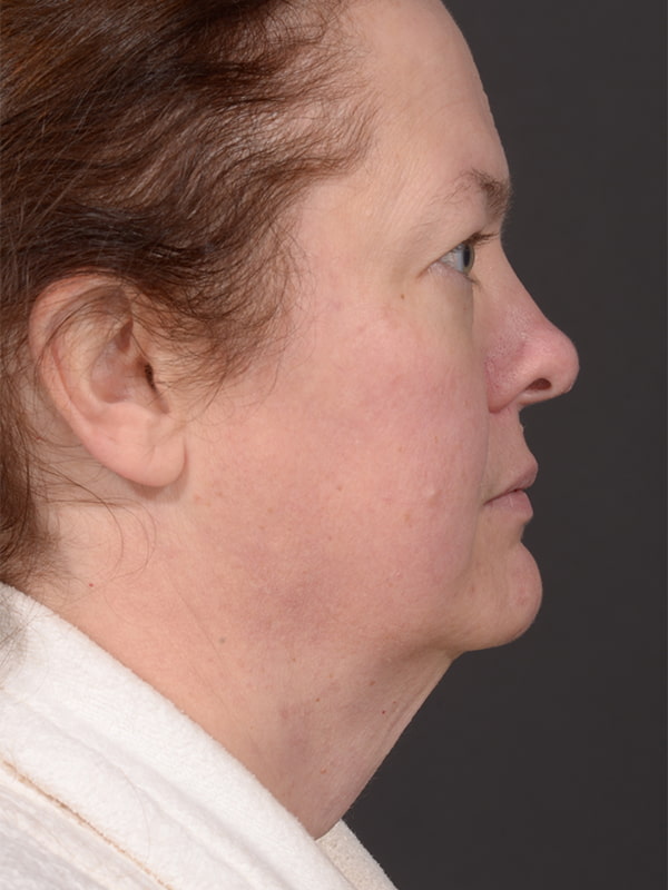 Face and Neck Lift Before & After Image