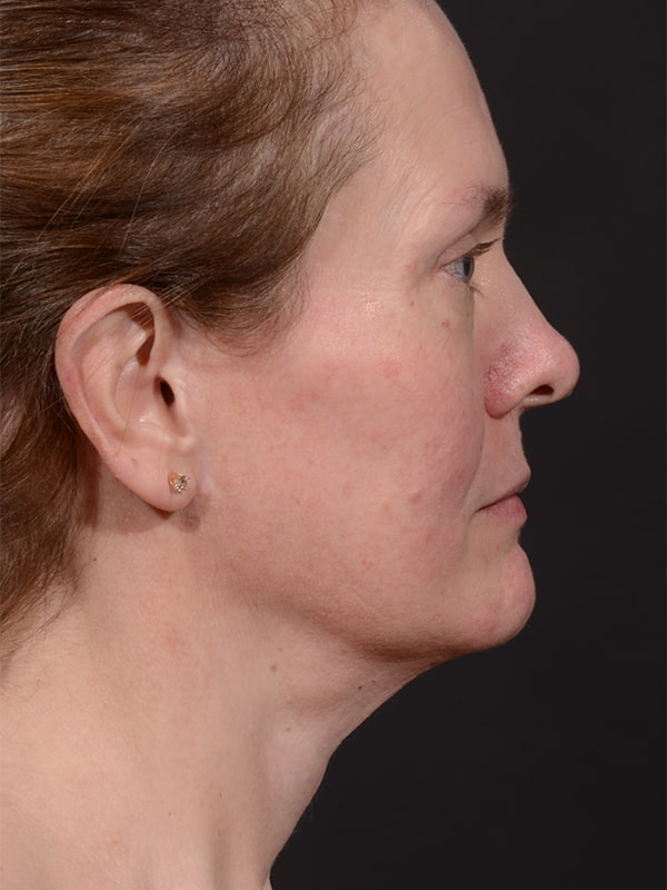 Face and Neck Lift Before & After Image